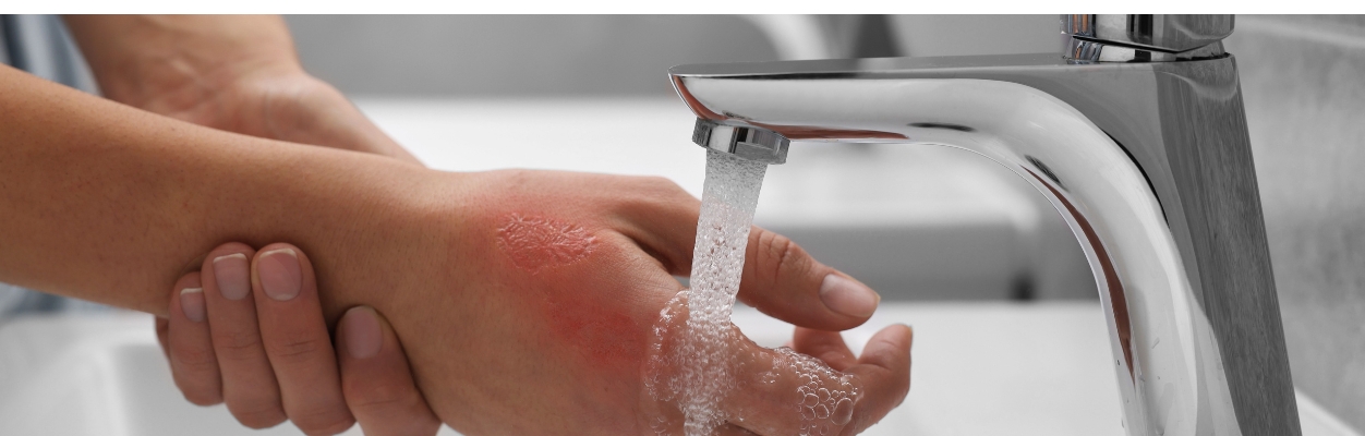 Person holding burn under running tap